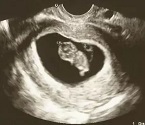 УЗИ срока беременности 9 недель