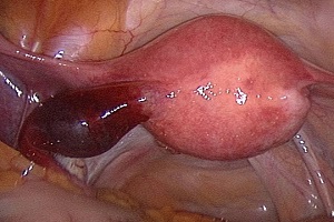 Кровоизлияние в оболочку кисты правого  яичника