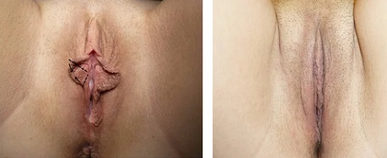 Гениталии женщины перед операцией и после нее